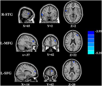 Arterial Spin Labeling Cerebral Perfusion Changes in Chronic Tinnitus With Tension-Type Headache